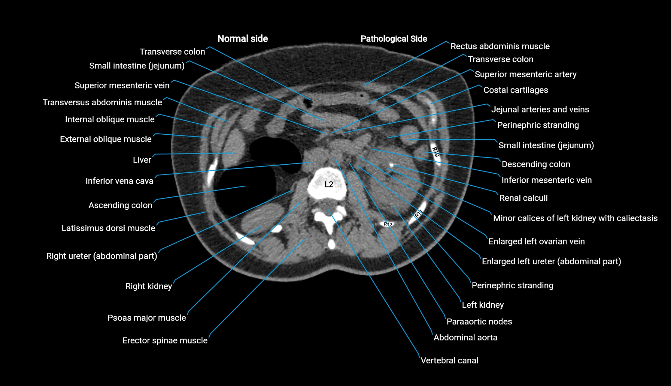 CT KUB axial cross sectional anatomy  radiology image -img-00201-00052.webp